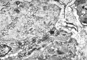 F,25y. | myopathy - atrophic and regenerating muscle cells F,25y. | myopathy - atrophic and regenerating muscle cells